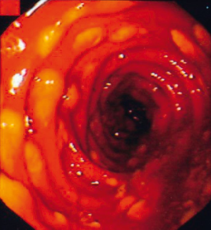 Endoscopic view of pseudomembranes associated with Clostridioides difficile