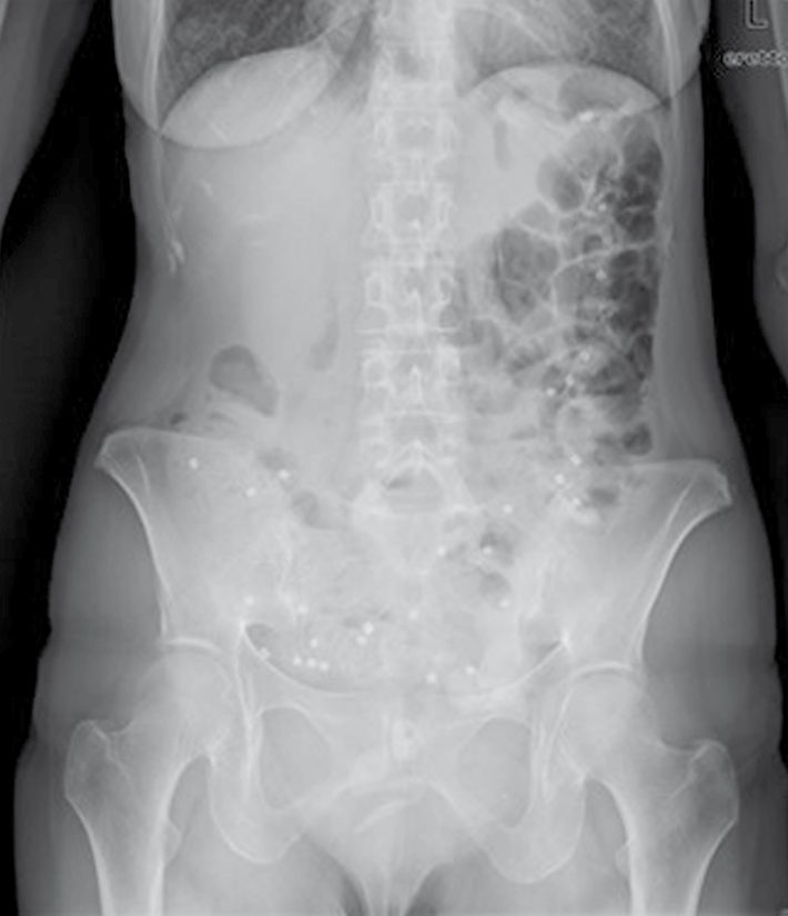 Colonic transit study: plain abdominal films at 3, 5 and 7 days after ingestion of markers