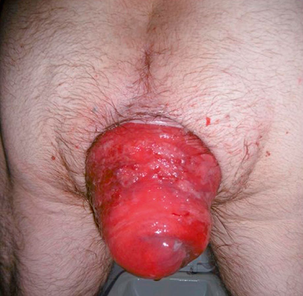 A patient with a large external full-thickness rectal prolapse, showing the characteristic circumferential mucosal folds