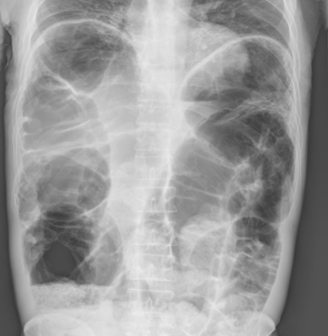 Plain abdominal film in slow-transit constipation with megacolon
