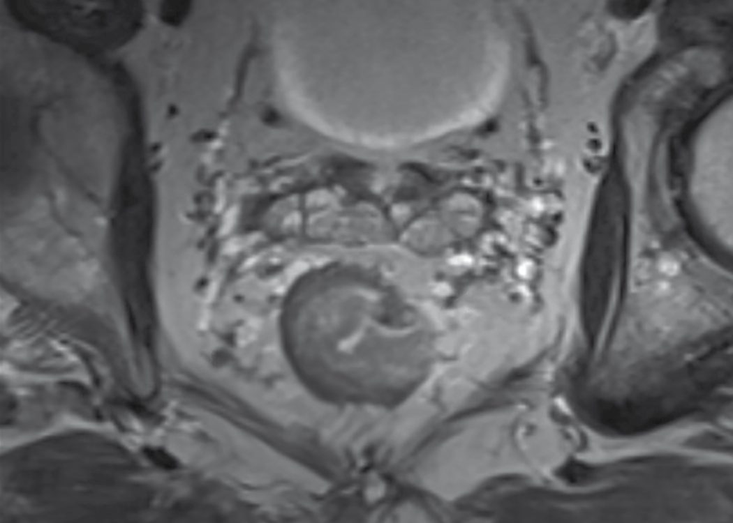 Axial T2-weighted pelvic MRI of a rectal cancer penetrating the rectal wall into the mesorectal fat with abnormal mesorectal nodes: clinically staged T3N1