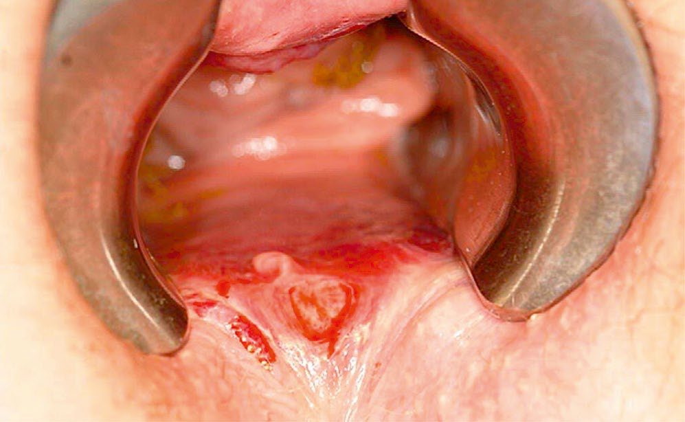 Acute anal fissure seen through an anal retractor