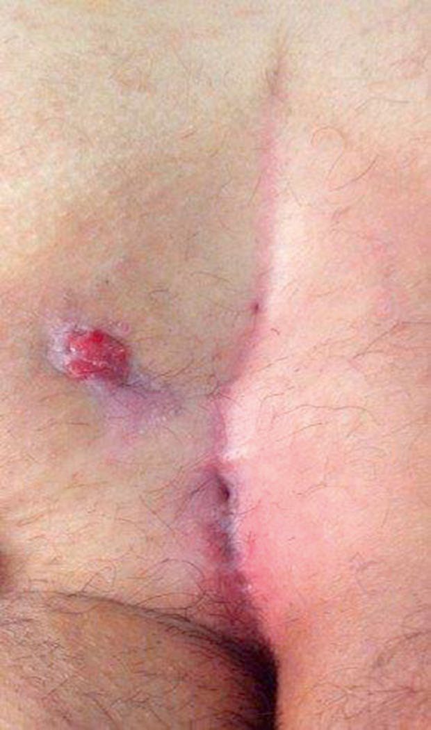Pilonidal sinus disease: midline natal cleft pits with an inflamed secondary opening lateral to the midline