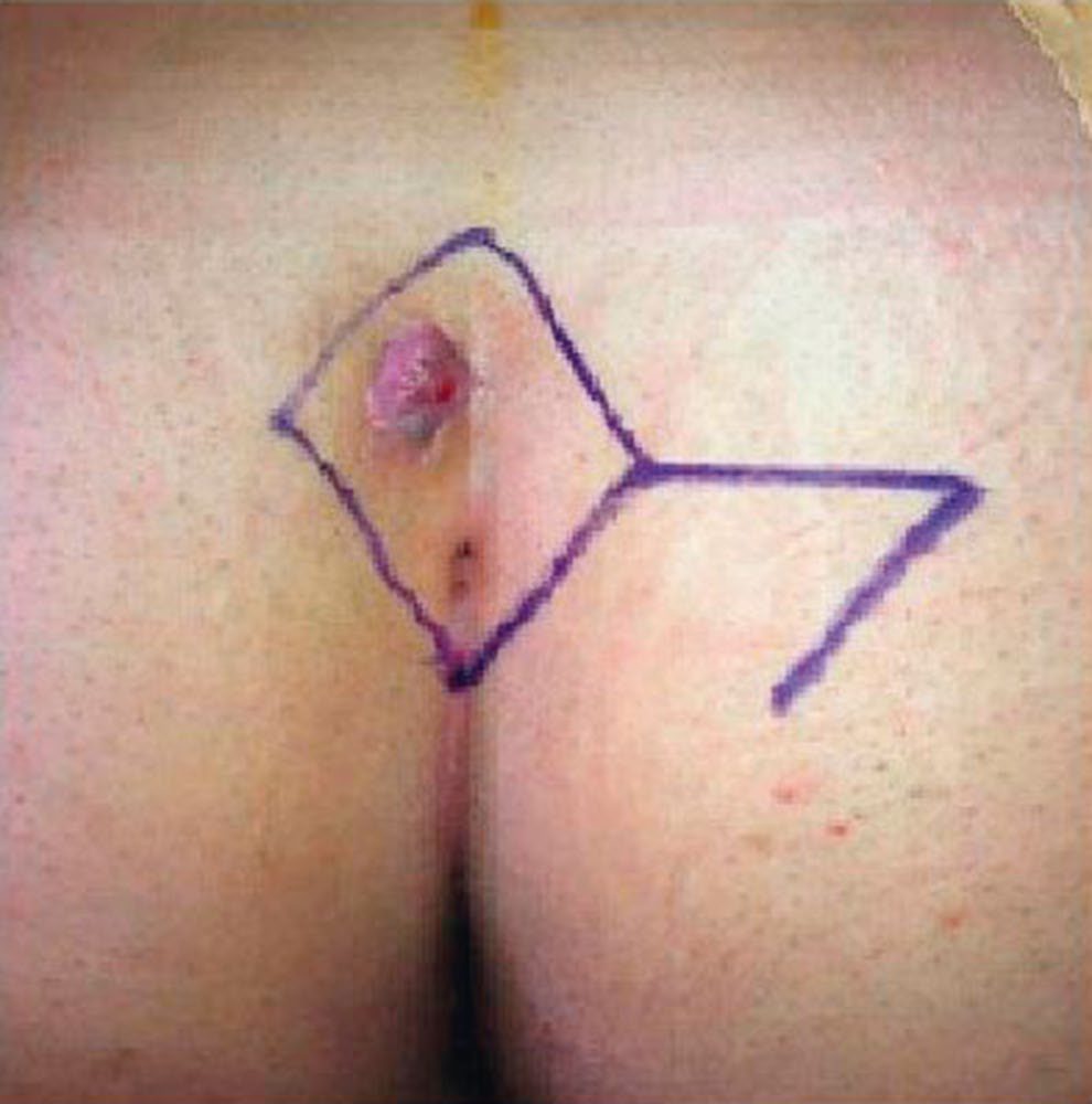 Limberg flap for pilonidal disease: initial marking of the rhomboid excision and the measured rotation flap