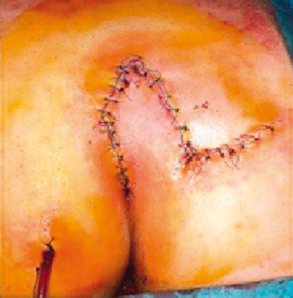 Limberg flap: initial marking of the proposed incision, and the completed rotation of the flap