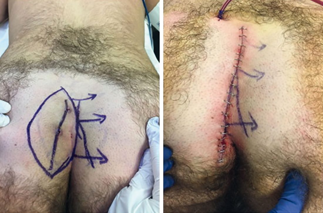Bascom cleft lift. (A) An eccentric ellipse is planned to include all midline and secondary sinuses. (B) Result at completion: the natal cleft is flattened and the suture line lies off midline