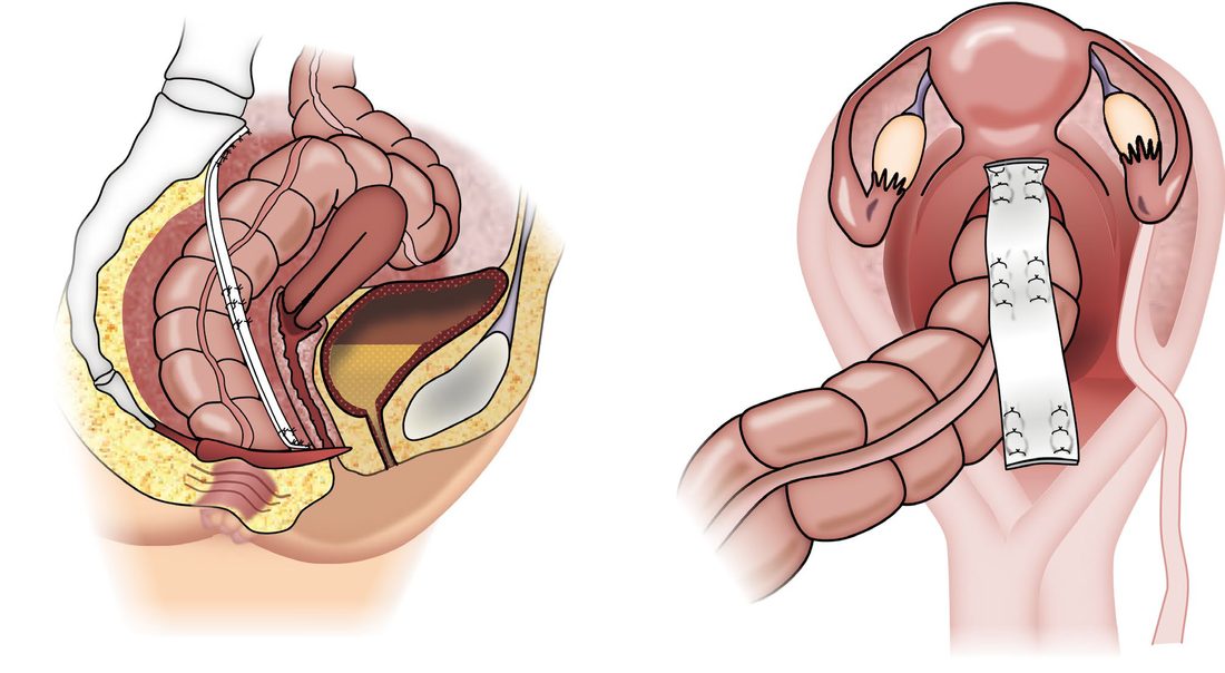 Ventral mesh rectopexy: mesh is sutured to the anterior rectal wall in the rectovaginal septum and suspended from the sacral promontory. (A) Lateral view. (B) Top-down view
