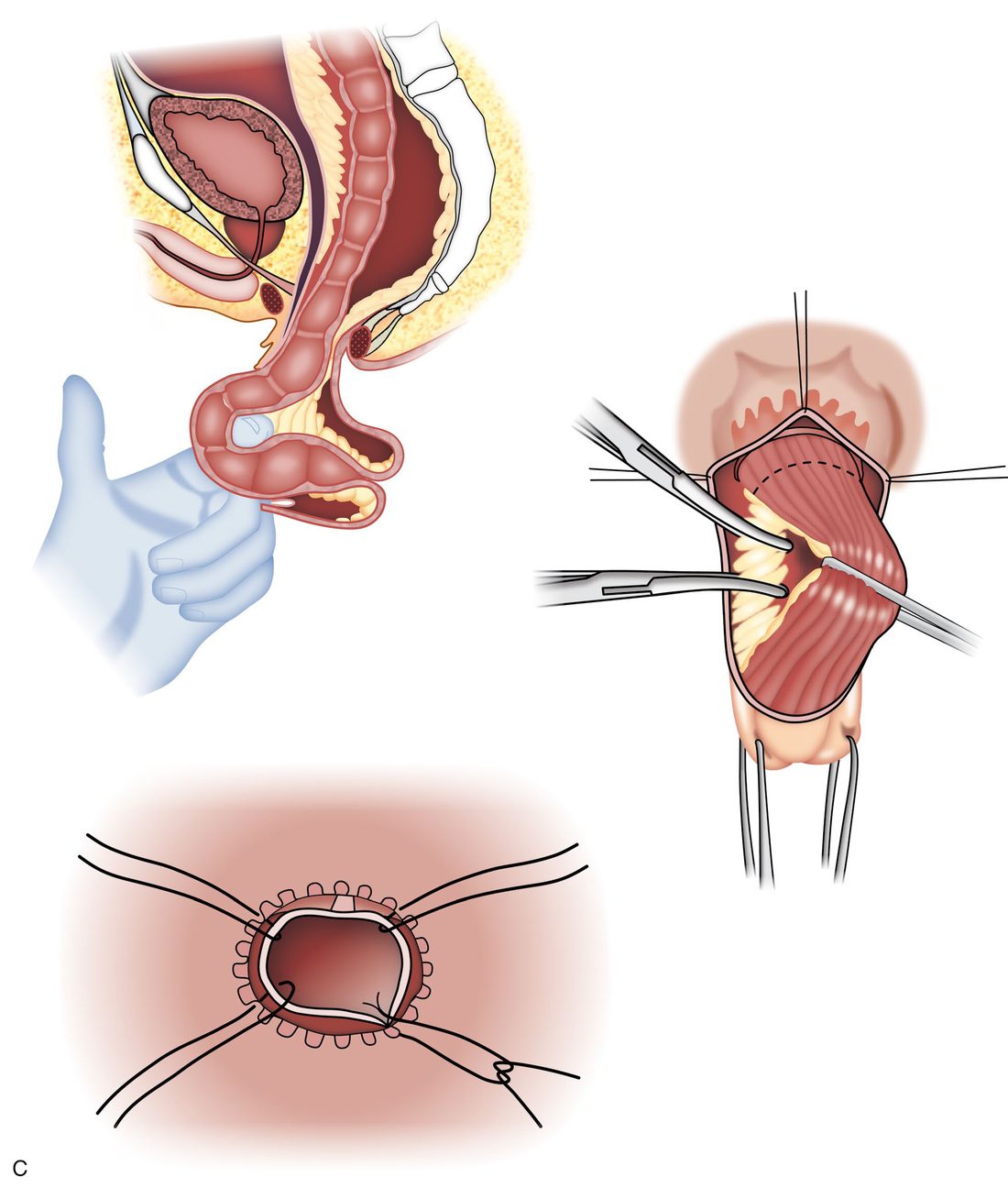 The Altemeier perineal proctosigmoidectomy: full-thickness excision of the prolapsed bowel with division of the sigmoid mesentery and a hand-sewn coloanal anastomosis