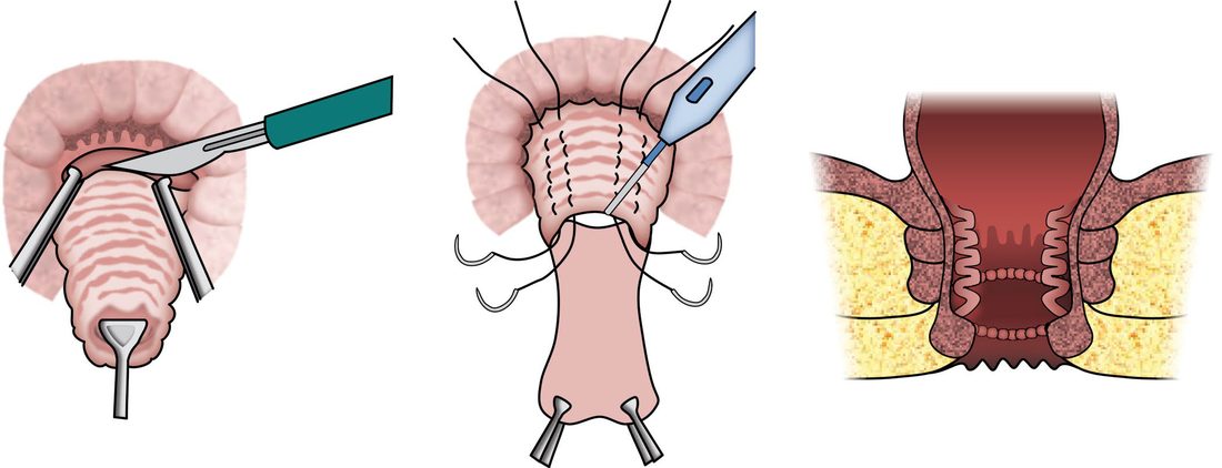 Delorme's procedure: circumferential mucosal stripping of the prolapsed segment, plication of the denuded muscle tube, and mucosal reapproximation
