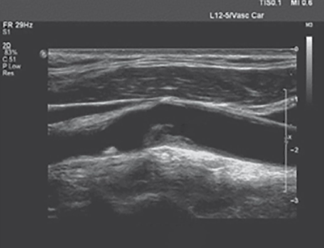 Duplex ultrasound showing plaque (arrows) in the carotid artery