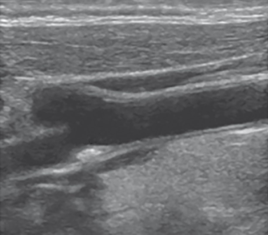 Duplex ultrasound showing atherosclerotic plaque narrowing the carotid artery