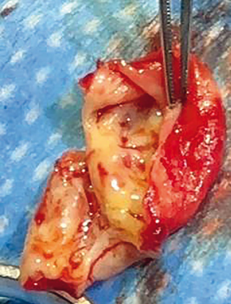 Carotid endarterectomy: the atheromatous plaque specimen removed from the carotid bifurcation