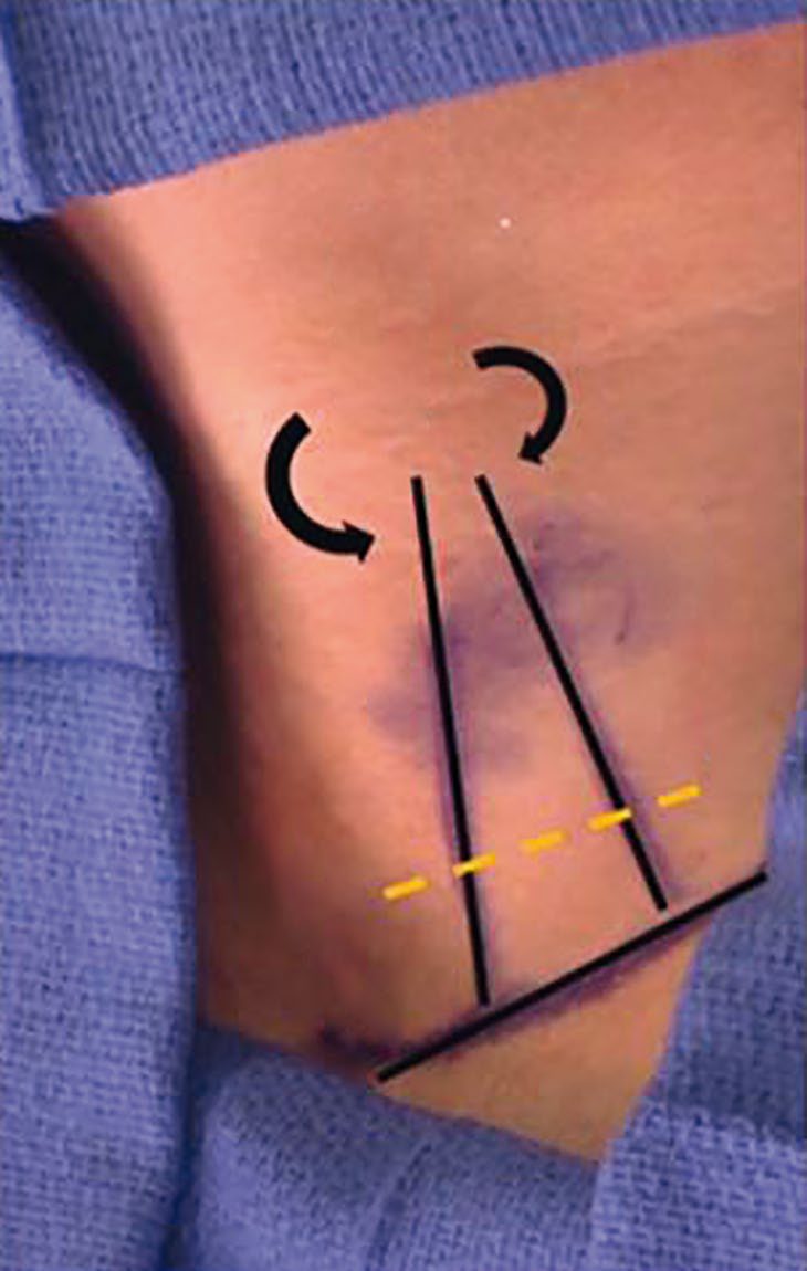 Anatomic landmarks for cut-down onto the common carotid artery during transcarotid artery revascularisation