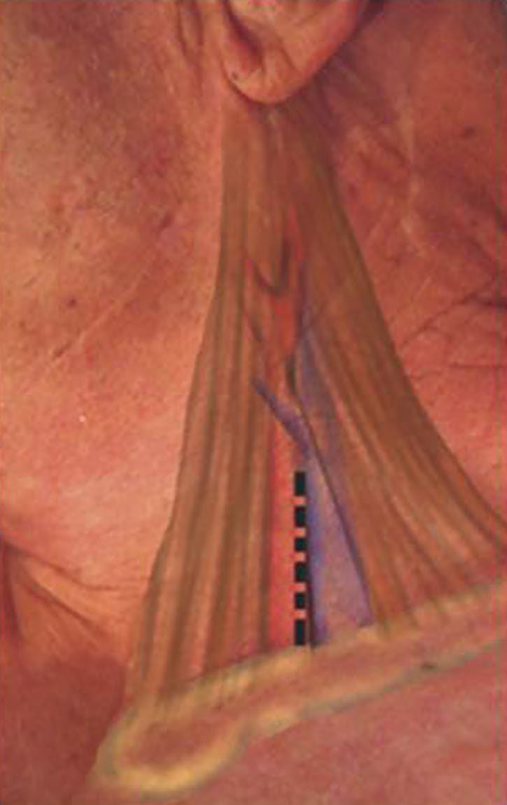 Anatomical landmarks for cut-down on the common carotid artery during transcarotid artery revascularisation