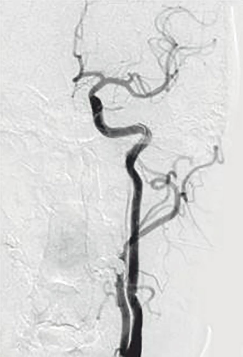 Flame taper in the distal carotid artery, and occlusion of the internal carotid artery