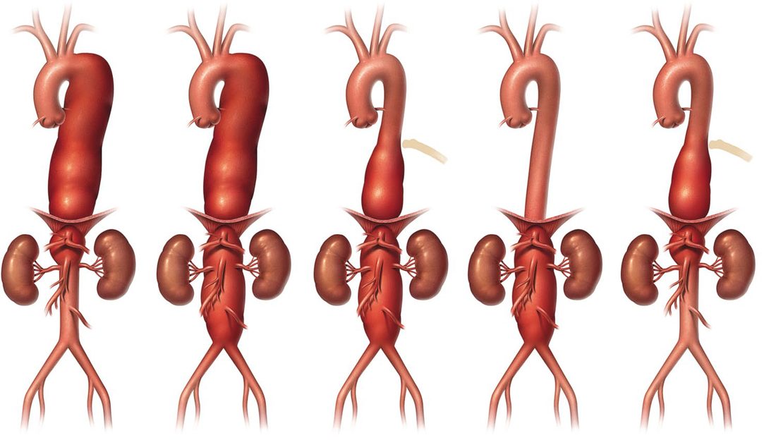 Modified Crawford classification of thoracoabdominal aortic aneurysms, extents I to V