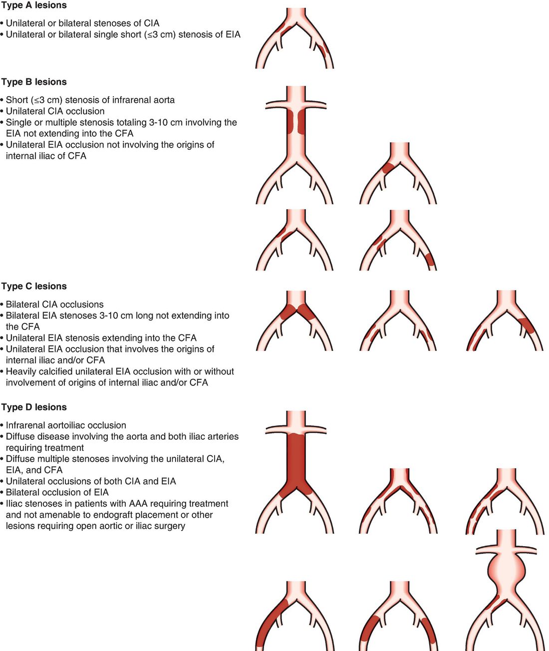 TASC II classification of aortoiliac lesions (types A to D), used to guide endovascular versus open revascularisation