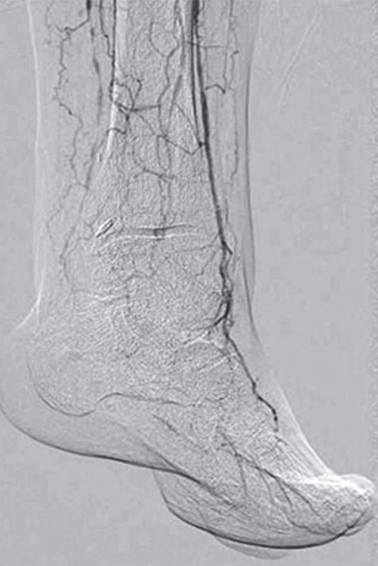 Angiography in critical limb ischaemia in a diabetic patient with great toe gangrene, showing long-segment tibial occlusion with distal anterior tibial reconstitution