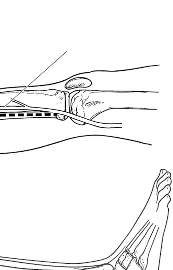 Lower extremity fasciotomy: release of the posterior compartments
