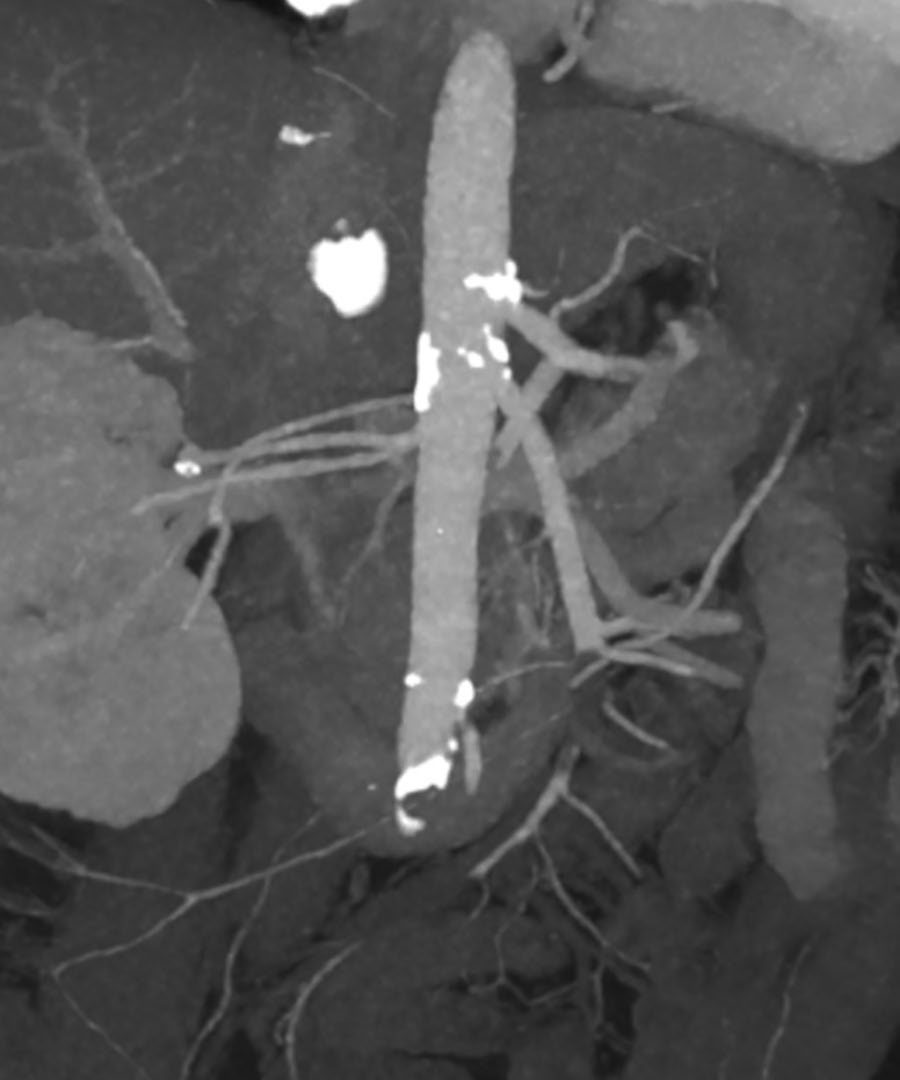 CT reconstruction, anterior-posterior and lateral, of an acute embolus to the mid superior mesenteric artery