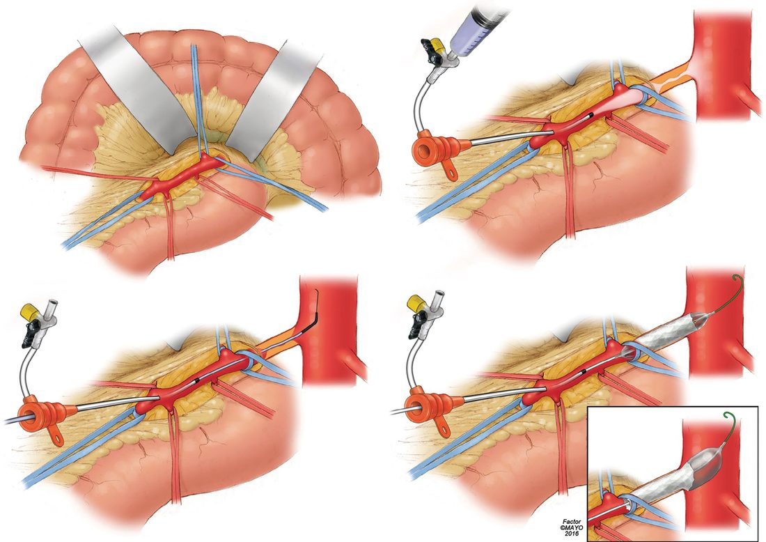 Technical steps for retrograde open mesenteric stenting, beginning with isolation of the infracolic superior mesenteric artery