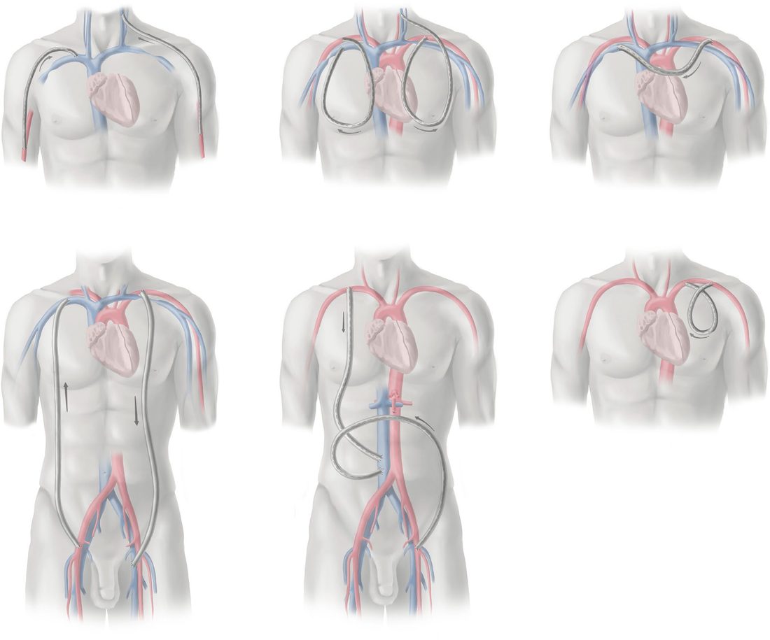 Alternative access configurations: cervical-based grafts, chest wall loop and necklace grafts, axillofemoral grafts and an arterioarterial prosthetic loop