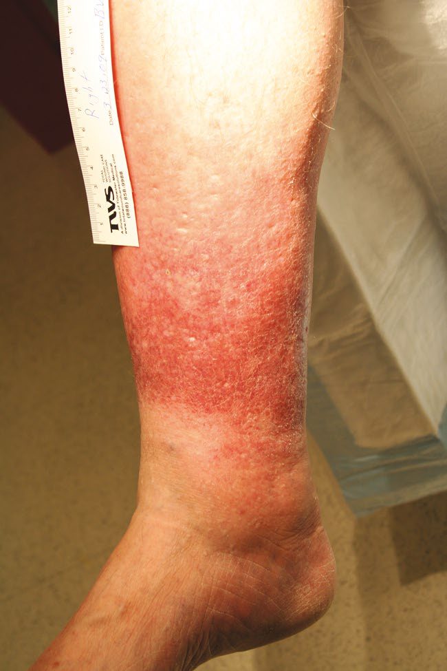 Lipodermatosclerosis with hyperpigmentation and brawny oedema, alongside a varicose vein