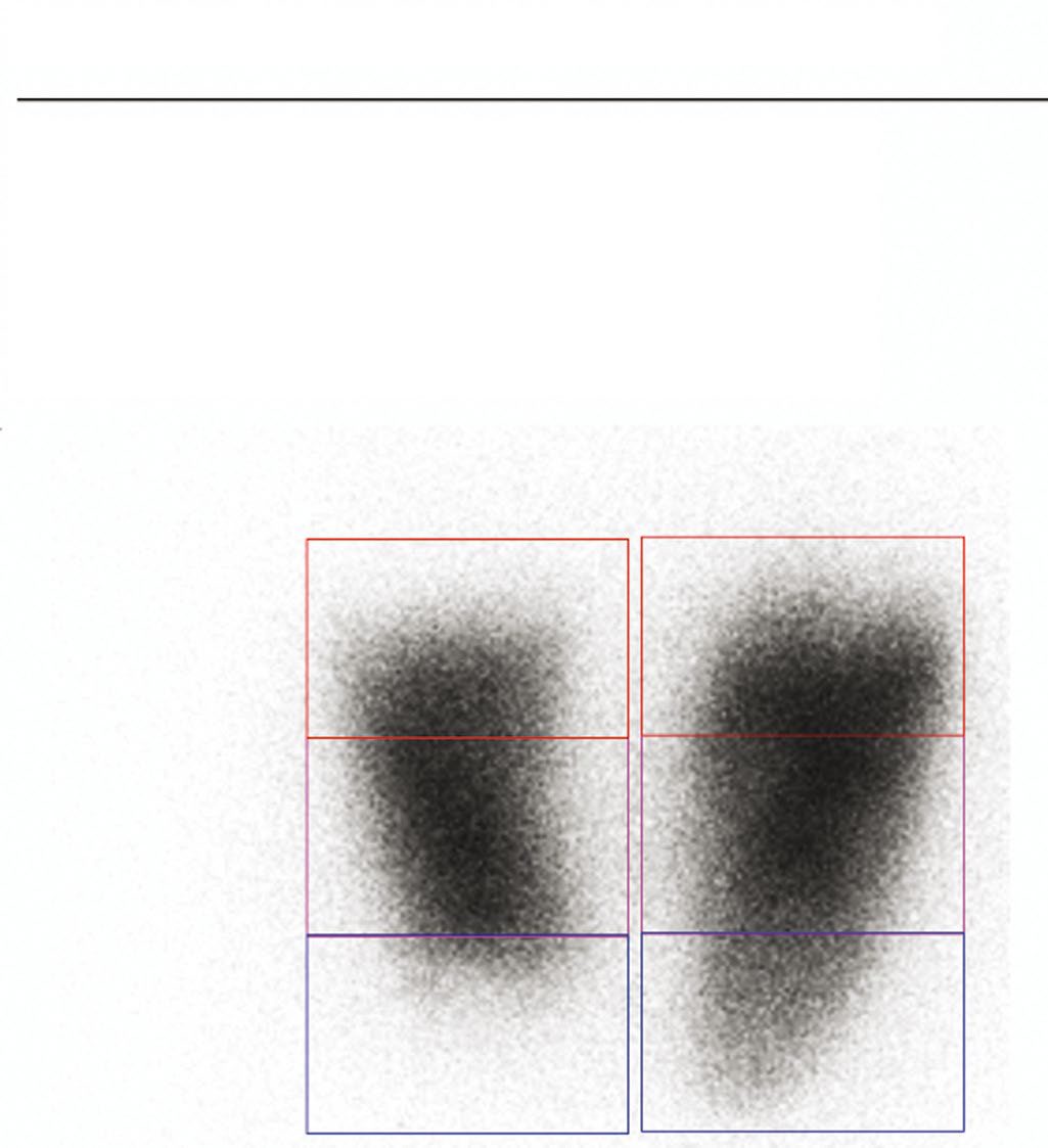 Quantitative perfusion lung scan, giving lung volume and the perfusion contribution of each lung
