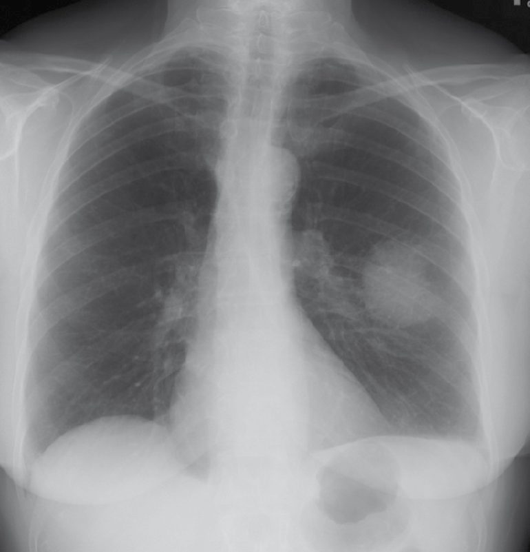 Radiographic evaluation of a patient with known or suspected lung cancer