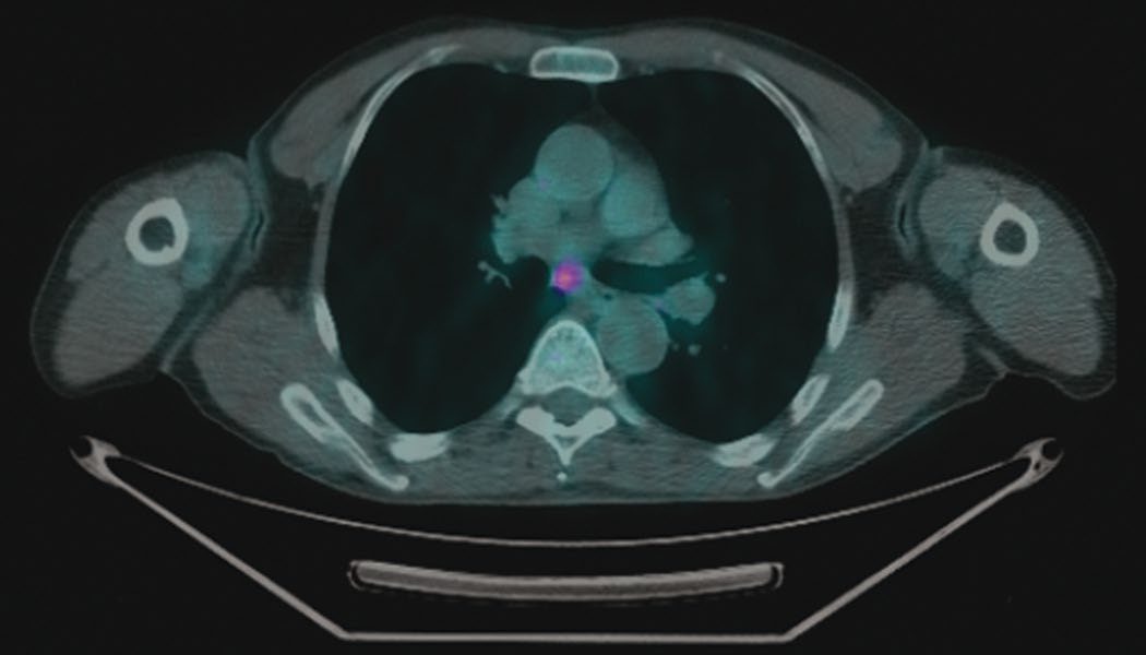 A subcarinal lymph node with mild FDG uptake on PET