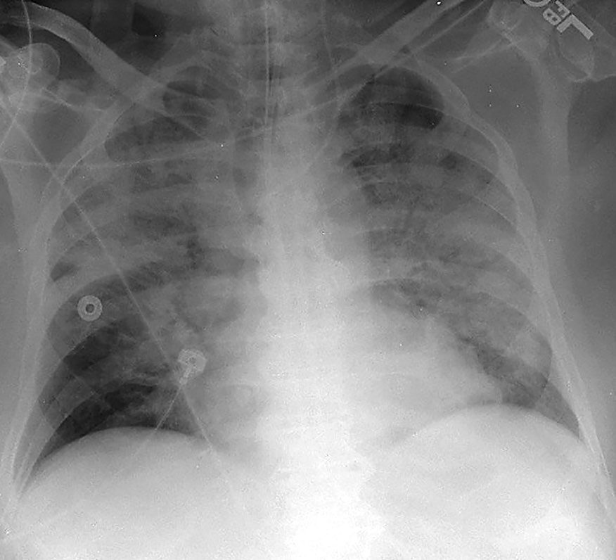 Frontal chest radiograph in acute respiratory distress syndrome