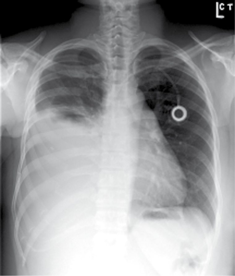 Malignant pleural effusion causing dyspnoea, managed with a long-term indwelling pleural catheter