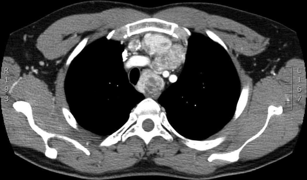 Thyroid carcinoma within the mediastinum, resected via median sternotomy