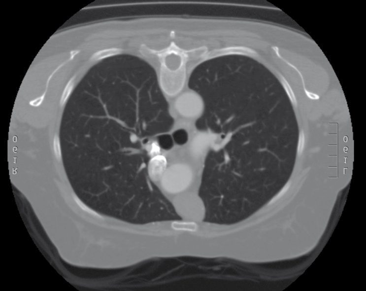 CT of the chest in a patient with myasthenia gravis