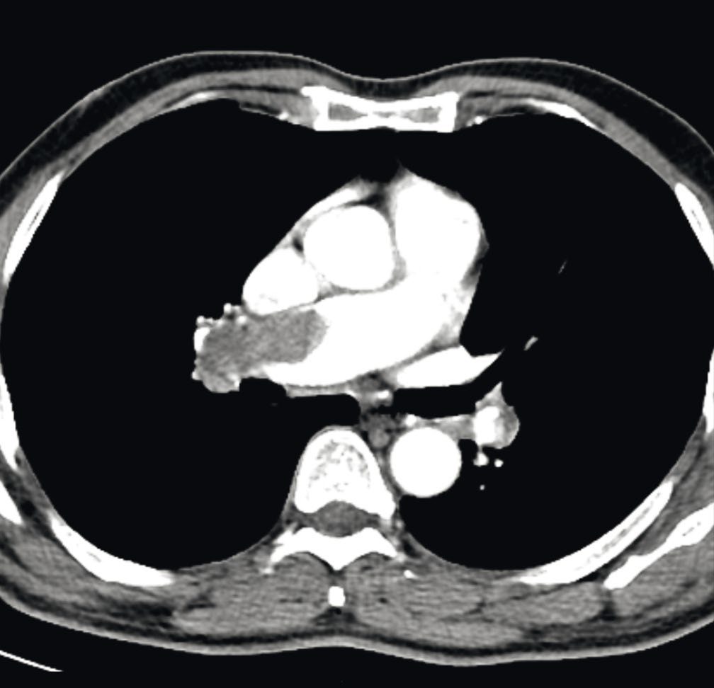 CT pulmonary angiography showing massive acute pulmonary embolism occluding the right pulmonary artery