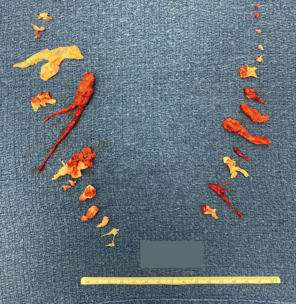 Specimen removed from the right and left pulmonary arteries of a patient with mixed acute, subacute and chronic pulmonary embolism