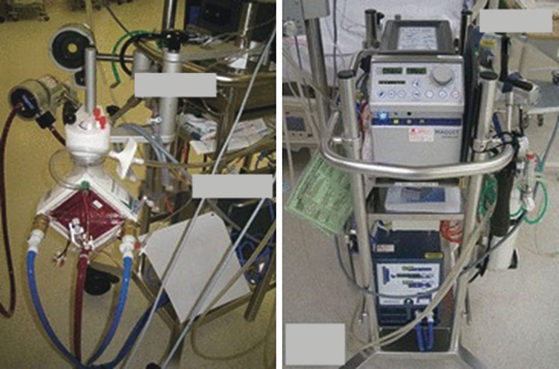 Extracorporeal membrane oxygenation circuit