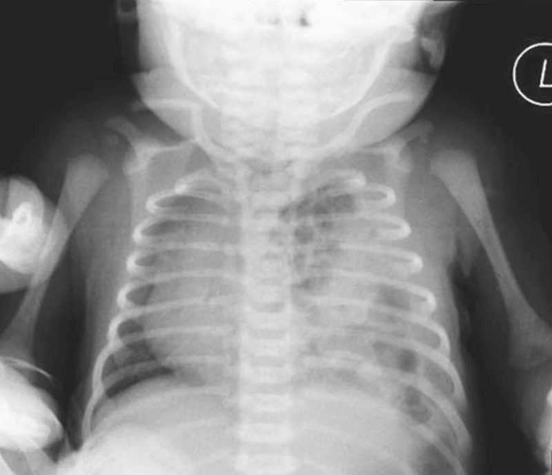 Congenital diaphragmatic hernia: multiple gas-filled bowel loops are located in the left hemithorax, and the mediastinum is shifted to the right