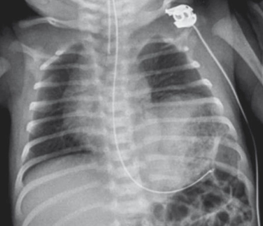 Congenital diaphragmatic hernia on chest radiograph: multiple gas-filled bowel loops occupy the left hemithorax