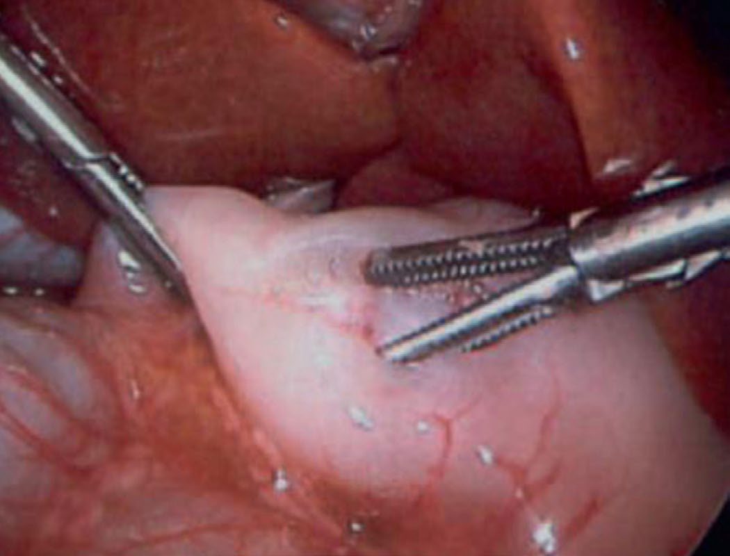 Laparoscopic pyloromyotomy, begun with a retractable blade or diathermy and completed by spreading the muscle fibres