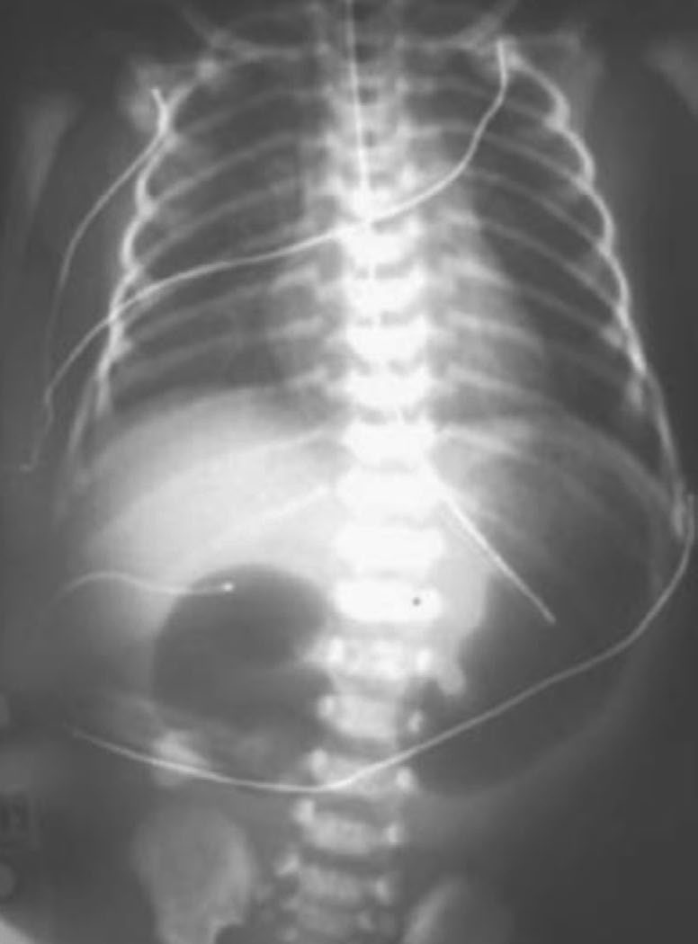 Plain abdominal radiograph showing the double-bubble appearance of duodenal atresia