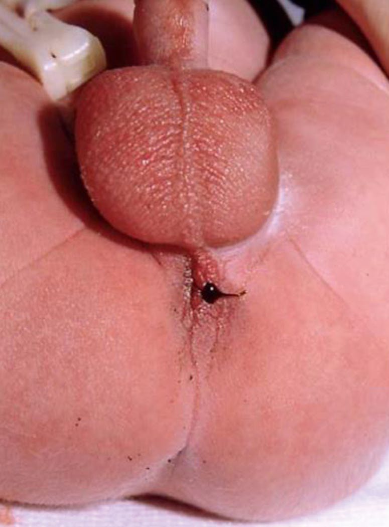 Imperforate anus with a perineal fistula opening, demonstrating meconium