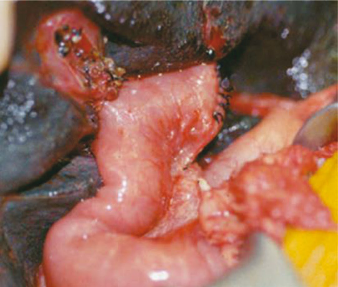 Kasai portoenterostomy: dissection of the fibrous extrahepatic biliary remnant
