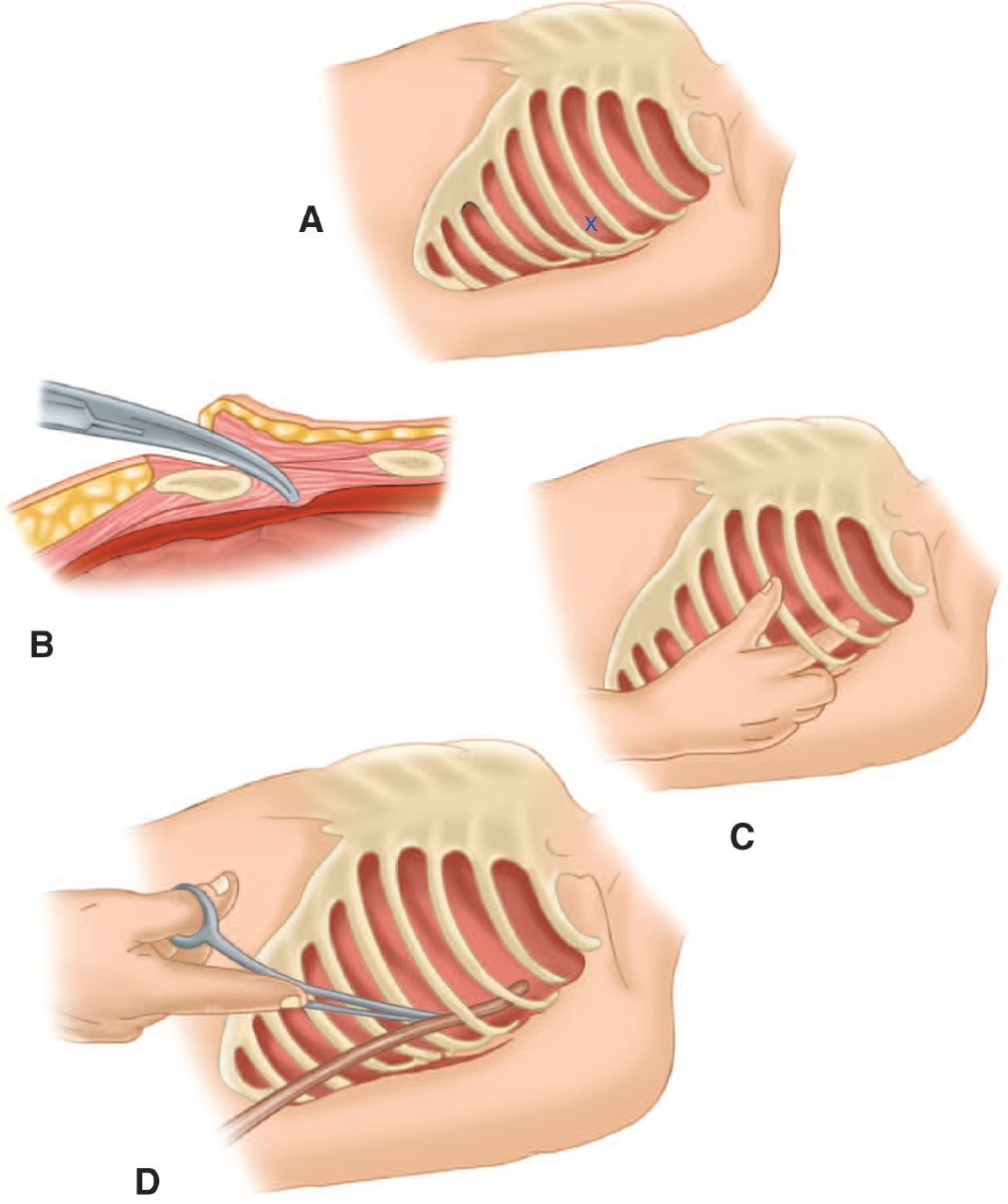 Tube thoracostomy: incision in the midaxillary line at the fourth or fifth intercostal space, blunt entry over the top of the rib, digital exploration of the pleural space, and directed tube placement