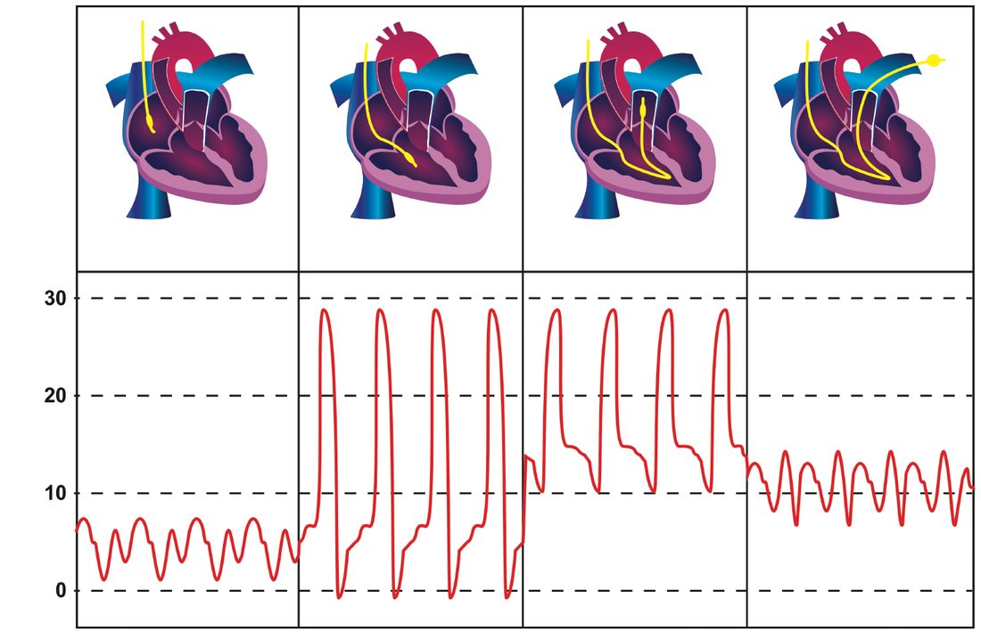 Representative pressure traces at successive stages of pulmonary artery catheter insertion: central venous, right ventricular, pulmonary arterial, and wedge