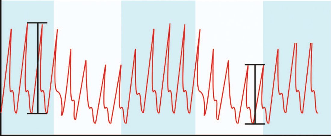 Calculation of pulse pressure variation as it appears on the bedside monitor, a rapid assessment of fluid responsiveness in the critically ill patient