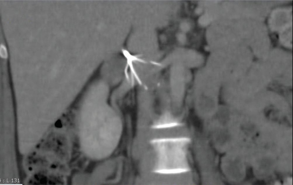 CT showing erosion of an IVC filter strut through the wall of the inferior vena cava