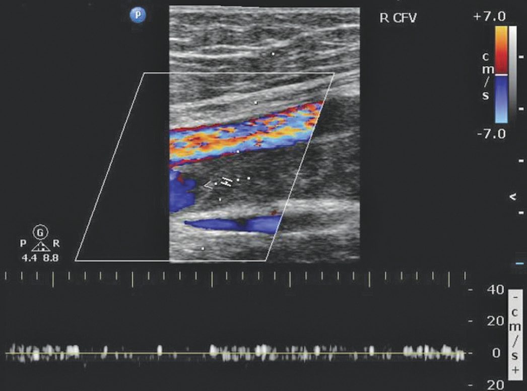 Duplex ultrasound of a femoral vein containing thrombus, demonstrating no flow within the femoral vein
