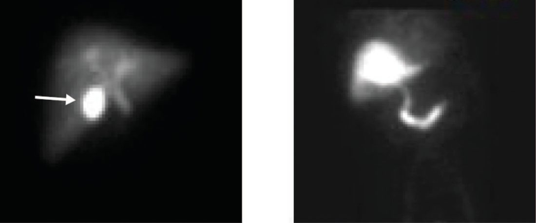 HIDA scanning: (A) normal scan showing filling of the extrahepatic biliary tree and gallbladder; (B) no filling of the gallbladder in acute cholecystitis