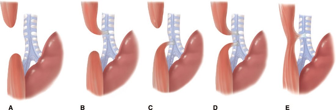 The five varieties of oesophageal atresia and tracheo-oesophageal fistula